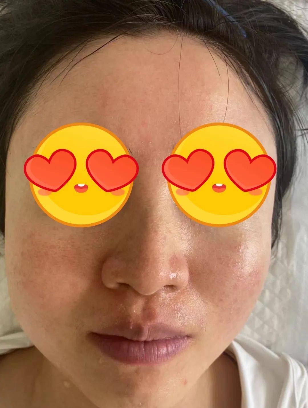 红黄光治疗:促进细胞增殖和调节炎性反应,改善水肿促进炎症消退.
