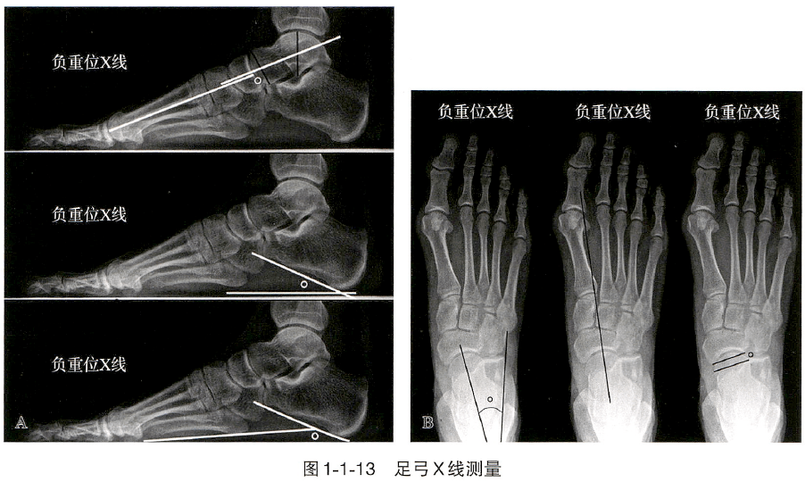 正常情況下, 測量距骨第1蹠骨角(meary角) .