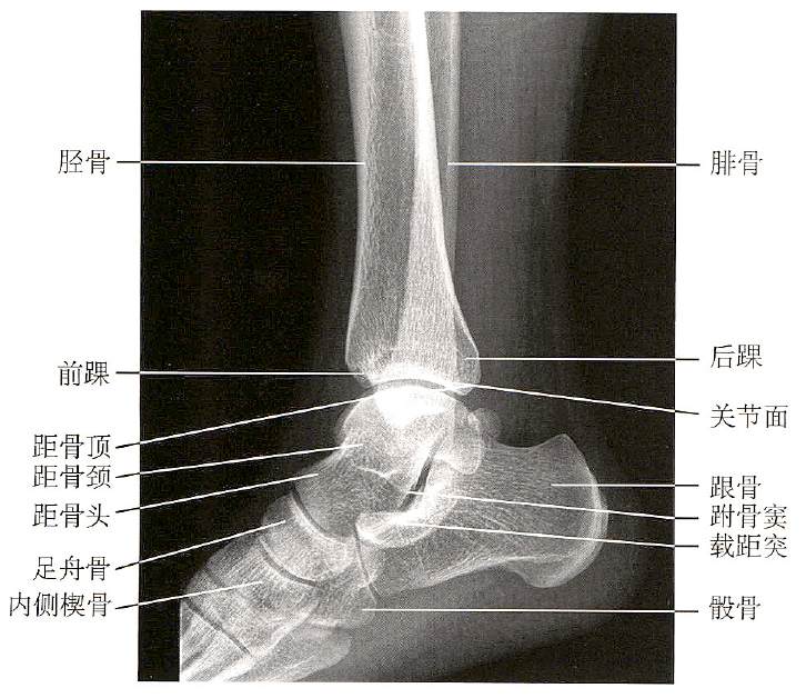 足踝關節解剖丨骨骼,關節,軟組織_韌帶_白箭_顯示