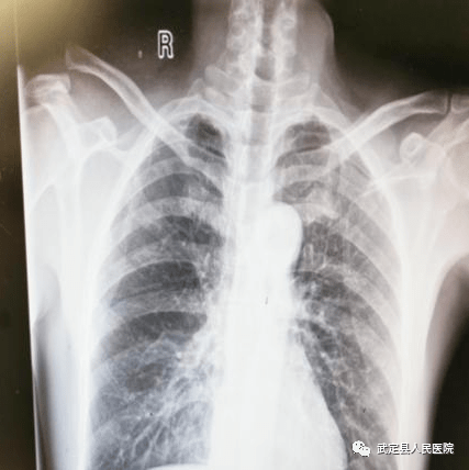 【新技术】武定县人民医院开展首例肩锁关节脱位小切口带袢钢板微创