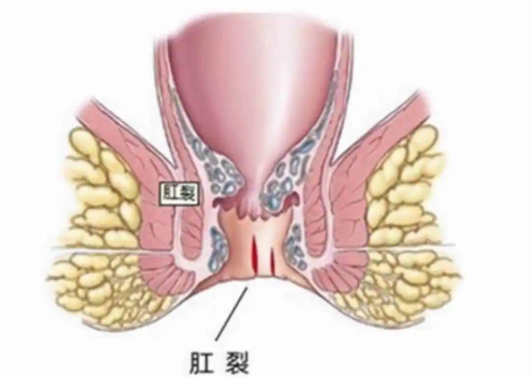 肛門_大便_症狀