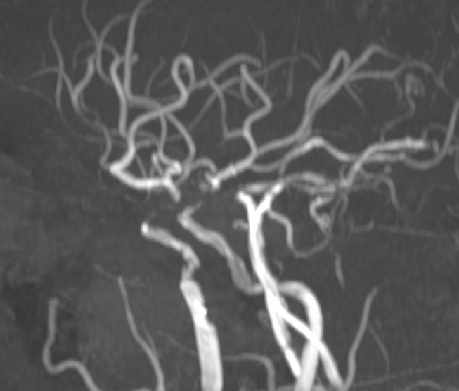 dsa:雙側頸內動脈閉塞;後循環通過雙側後交通及軟腦膜支向前循環有