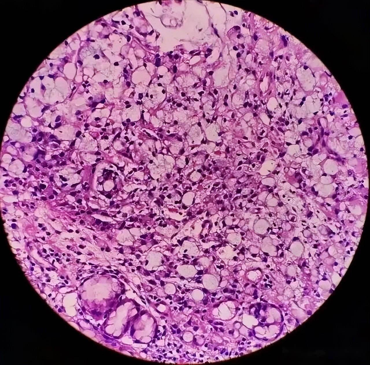 35岁女子,胃部不适3个月,查出晚期胃癌!_症状_医生_细胞