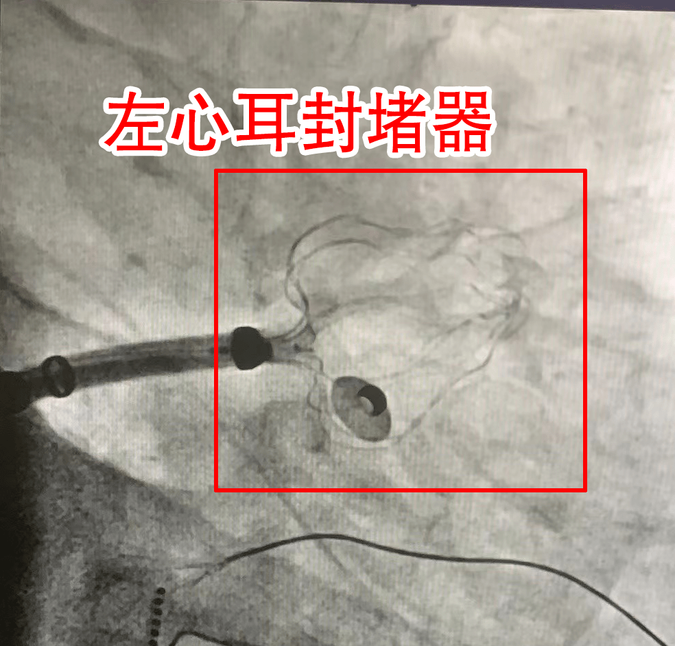 左心耳封堵術:不能或不願長期規律服用抗凝藥物有高出血風險,has-b