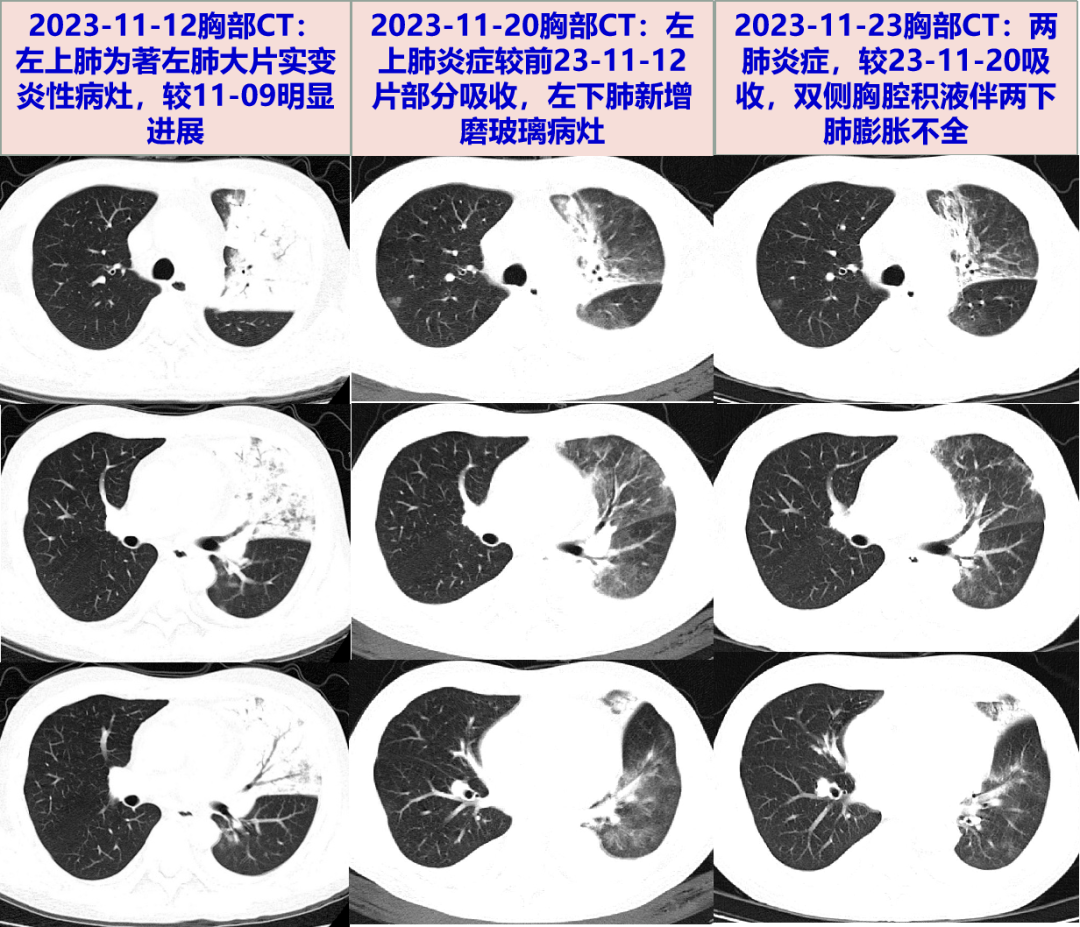 探案丨進展迅速的肺炎,你想到了什麼?_mg_mmol_病毒