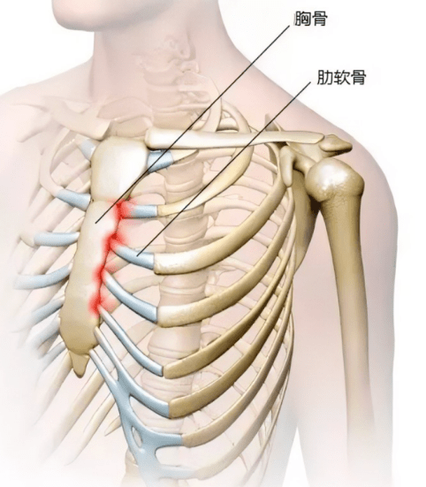 肋软骨炎的位置图图片