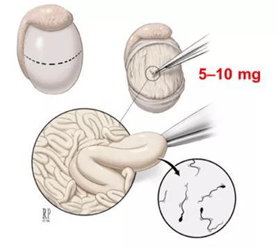 睪丸顯微取精術屬於微創,精細手術,手術歷時2-4個小時不等,術後4小時