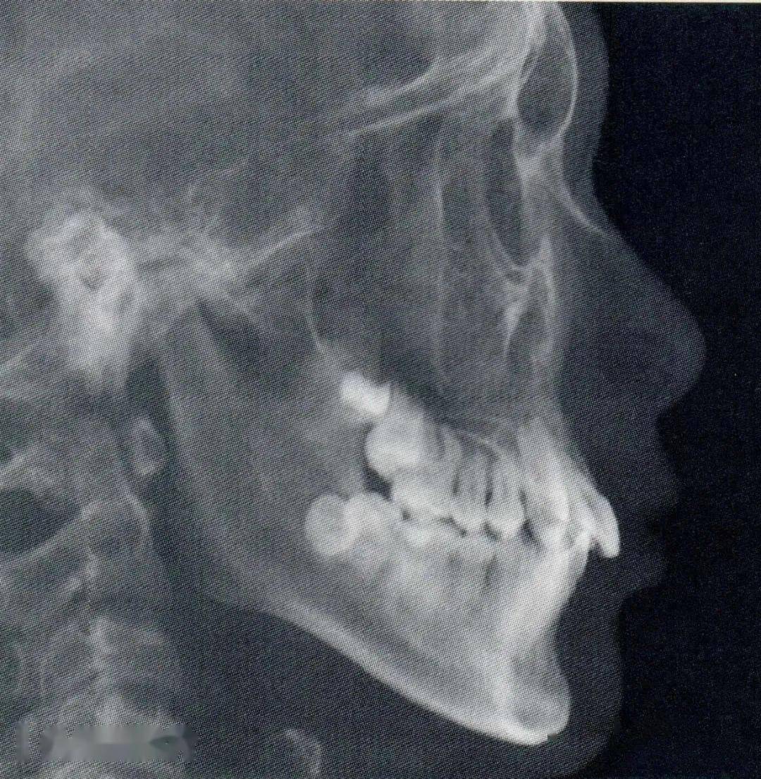 检查——骨性Ⅱ类凸面型高角深覆盖Ⅱ度深覆牙合Ⅲ度