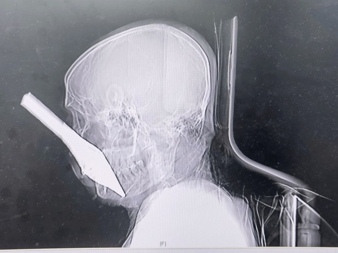 惊险 金属钢筋深插男子面部