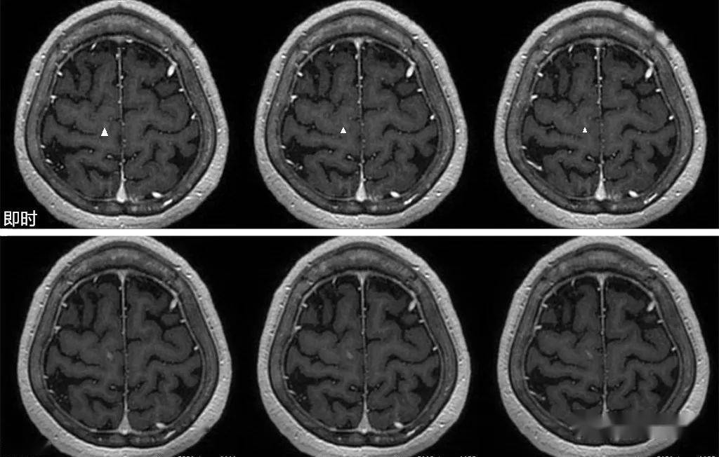 腦轉移瘤增強需要延遲多久掃描!_對比_病灶_min