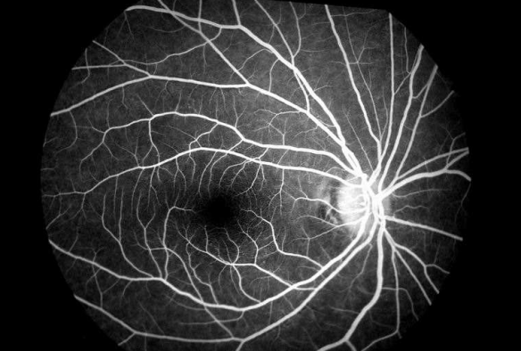 正常眼底荧光造影图片图片