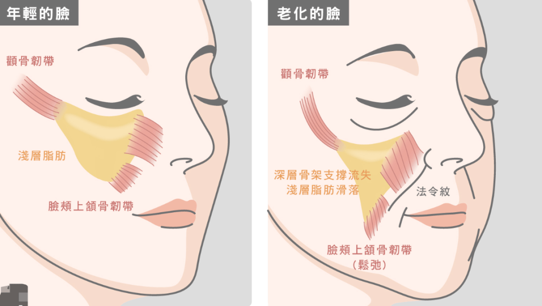 微拉美,u型提升,苹果肌脂肪室复位.真的好迷