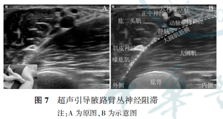 專家共識丨超聲引導臂叢神經阻滯的臨床應用與圍手術期