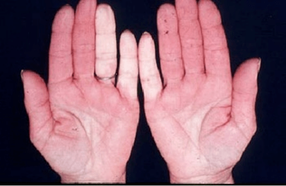 温州一医院今年就接诊1300人,其中90%为女性…_皮肤_症状_系统性