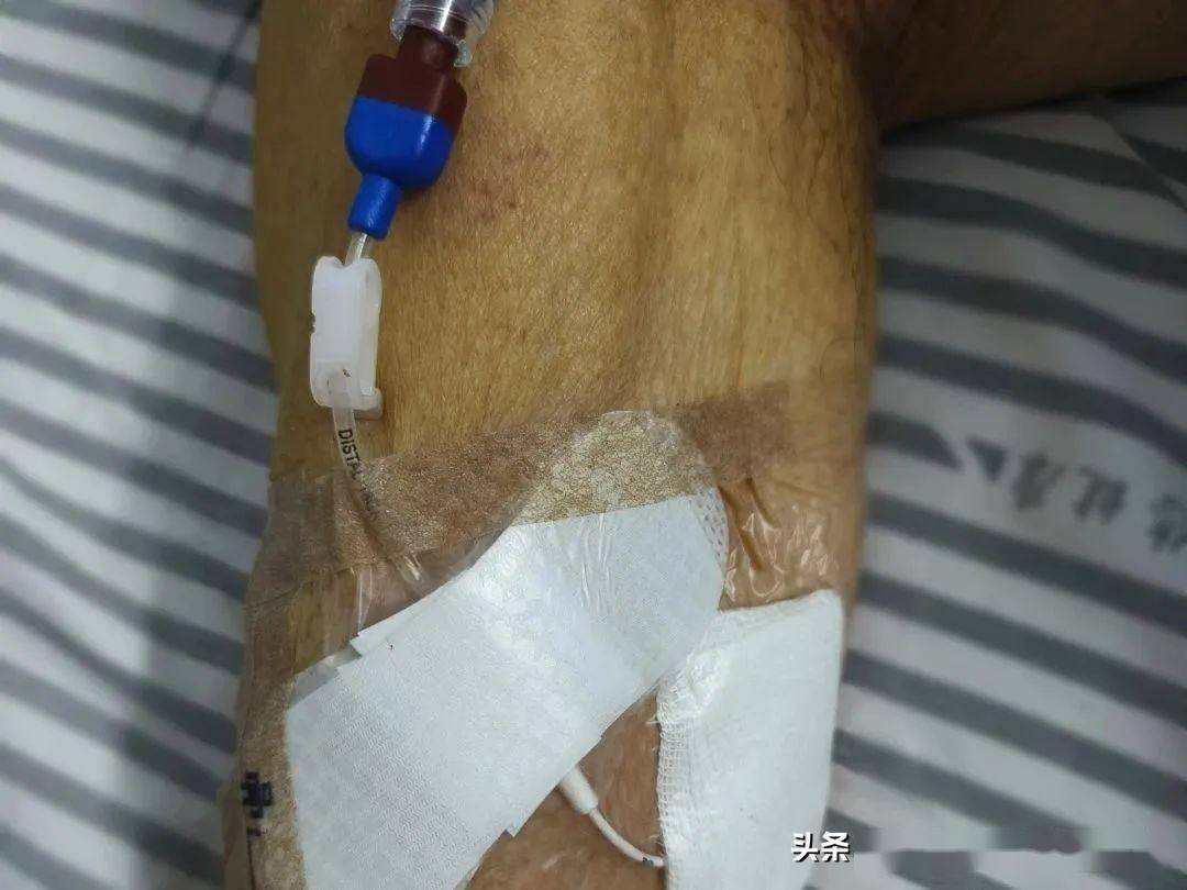 护理新技术丨中线导管中长期输液患者的新选择