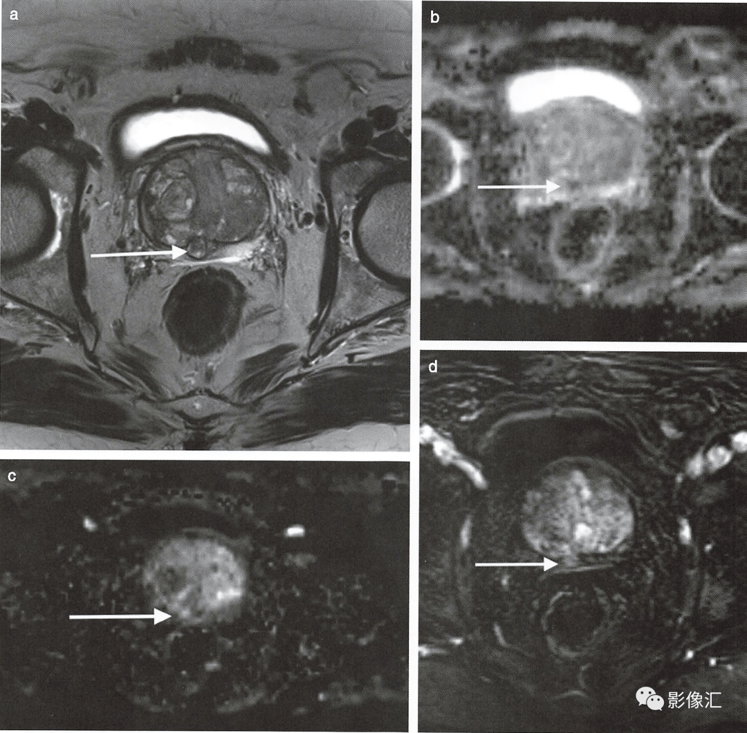 前列腺磁共振图像图片