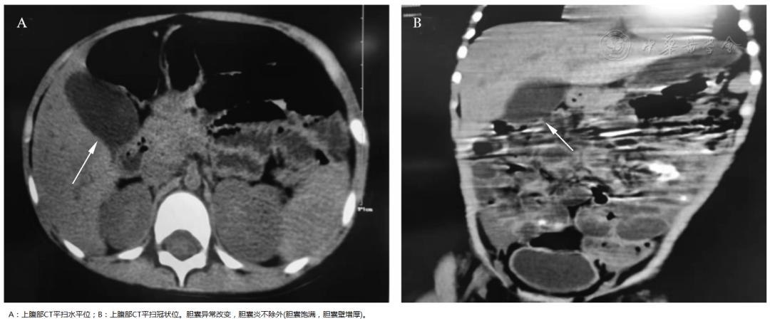 【臨床應用研究】川崎病再發且併發膽囊炎,假性腸梗