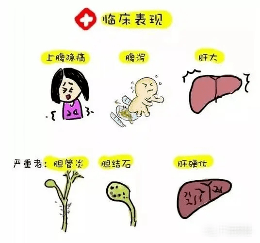 肝吸蟲病首選吡喹酮你用對了嗎?_進行_治療_飲食