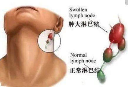 脾大的患兒應注意防治脾破裂;避免任何可能擠壓或者撞擊脾臟的動作;2