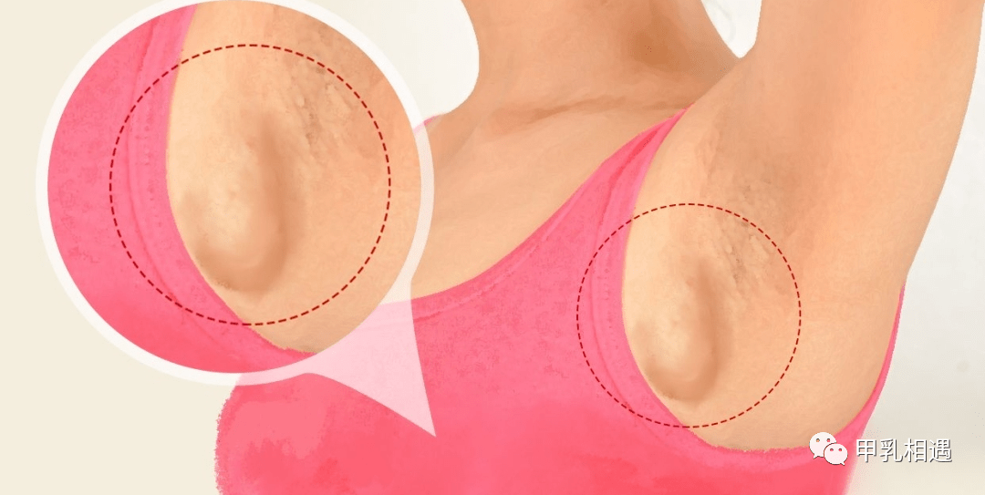 乳腺癌酒窝状凹陷图片图片