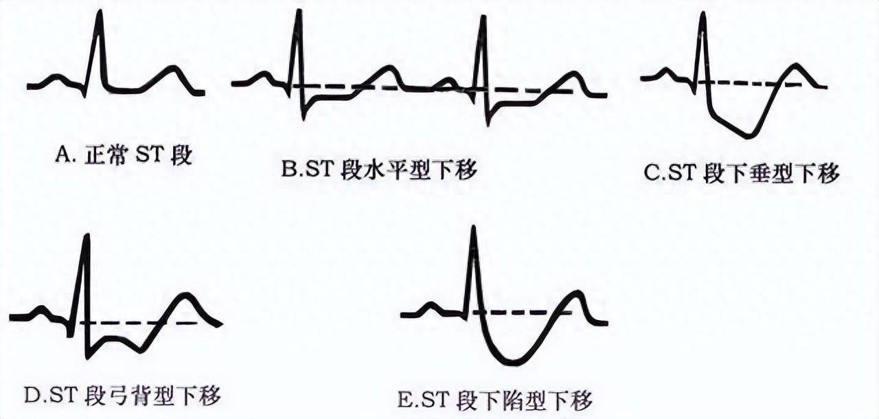 st-t改变心电图图片