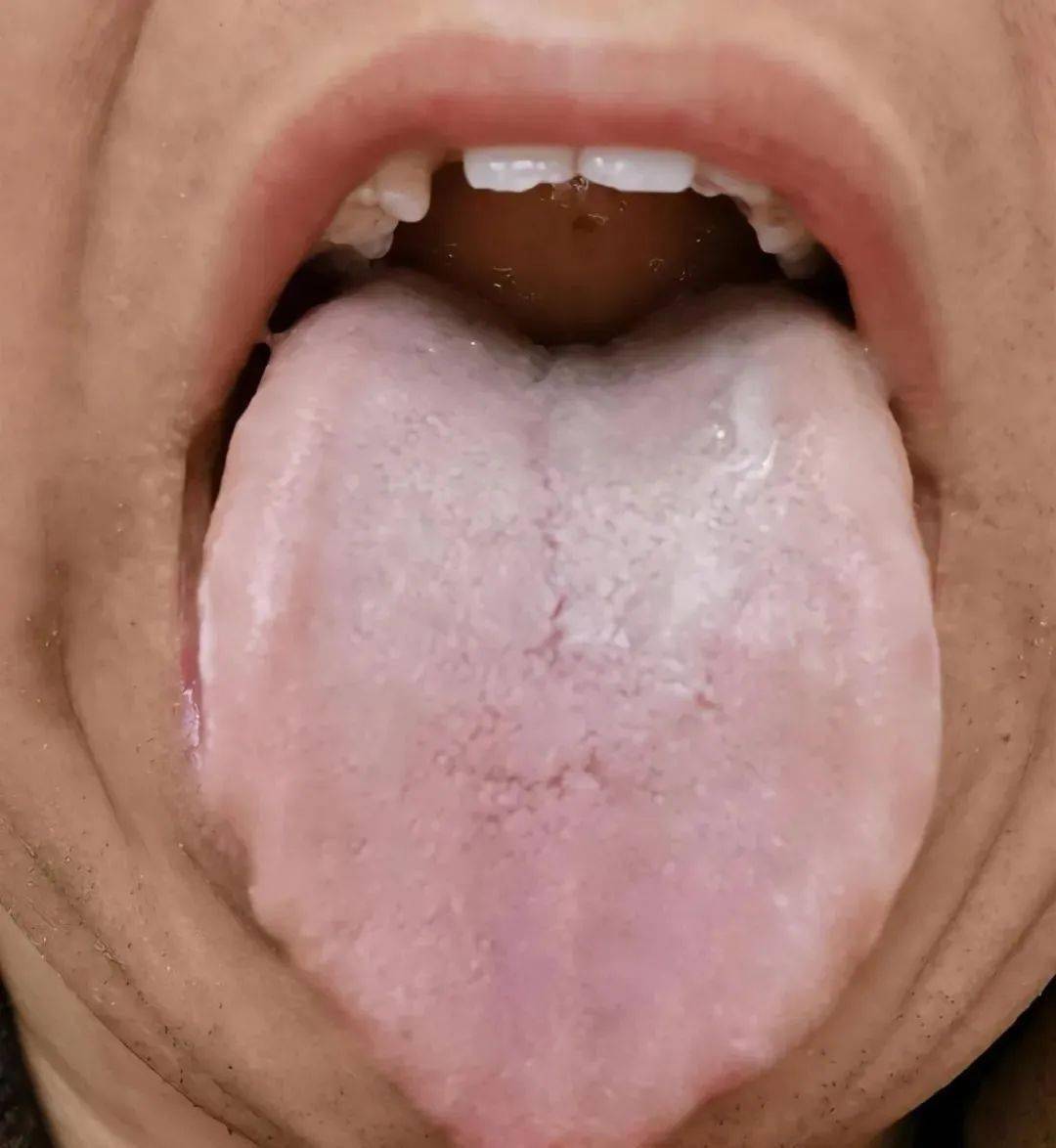 舌头有裂纹,体内脏腑易病变_患者_治疗_疾病