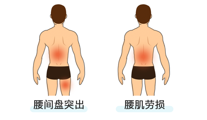 竖脊肌劳损图片