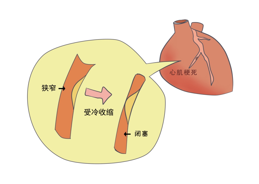 胸痛_患者_心臟