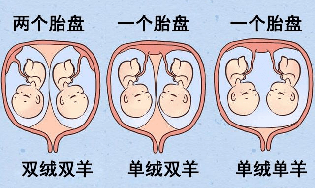 【科普】双胎妊娠知多少?_胎儿_妈妈_绒毛