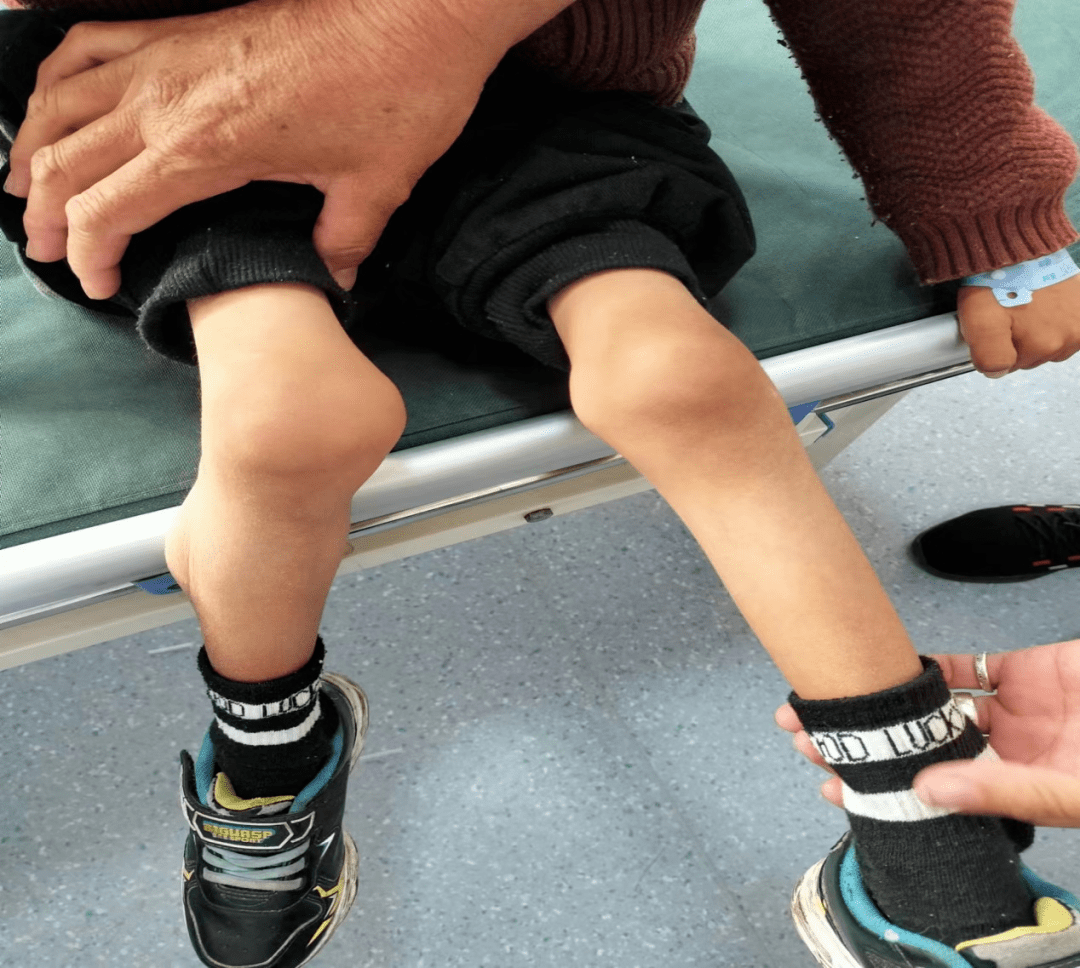 近日,丽江市宁蒗县人民医院儿科医护人员为一名患有先天性肌营养不良