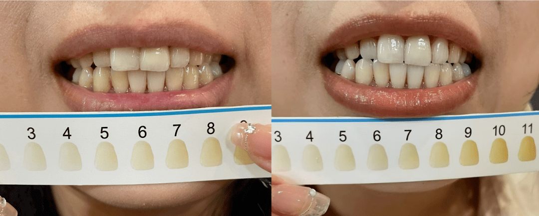 2 周前牙齿的整体颜色在比色卡的 6～8 之间,2 周后牙齿的整体颜色则