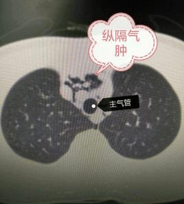 警惕縱膈氣腫_縱隔_氣體_壓力