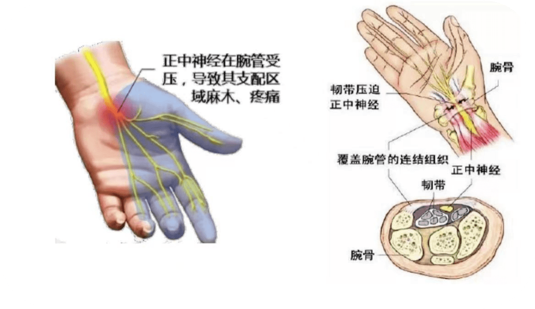 手麻不一定就是頸椎病哦_神經_綜合徵_麻木