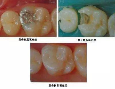 嵌體用金屬或其他材料製成與牙齒窩洞適合的修復體,鑲嵌在洞內.