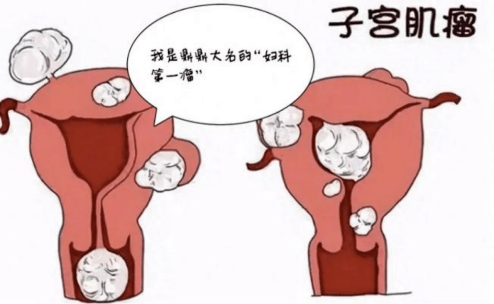 体检科普|妇科医生教你正确解读体检报告!_检查_宫颈_病变